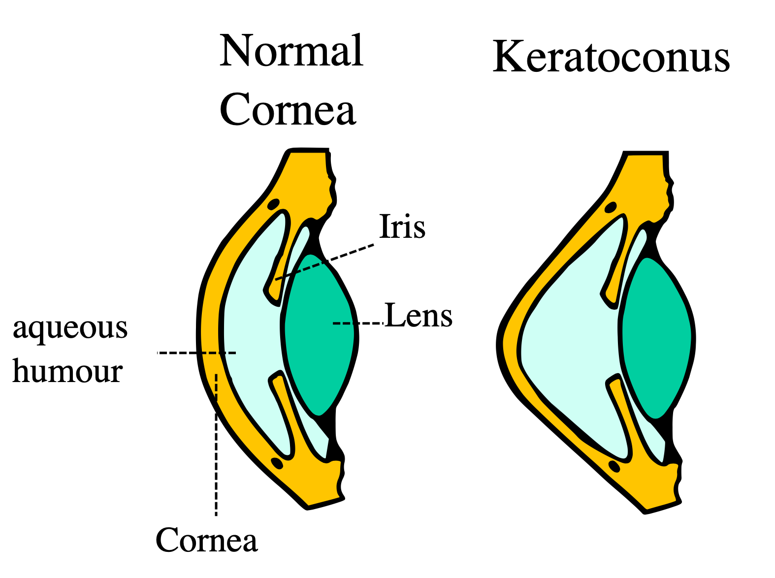 graphic of normal cornea vs keratoconus