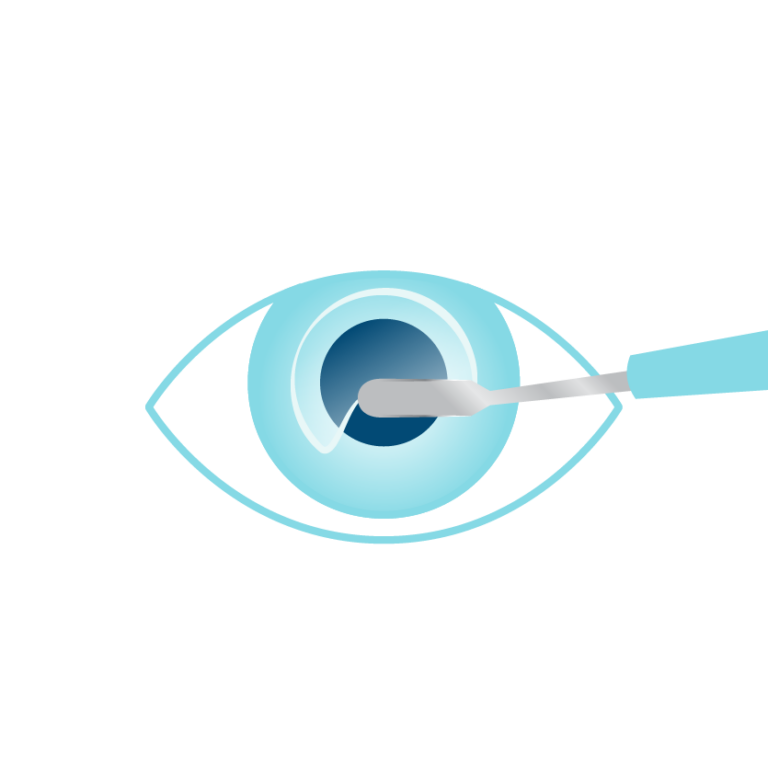 ASA PRK Surgery