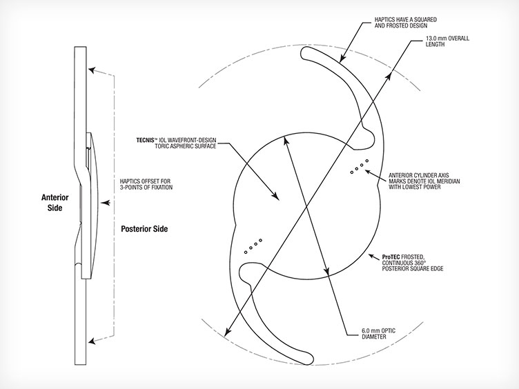 This diagram displays a toric lens used in ClearSight LASIK and Lens procedures, highlighting the anterior and posterior sides. It includes haptics, axis markers, and dimensions. Clearsight LASIK and Lens can treat astigmatism.
