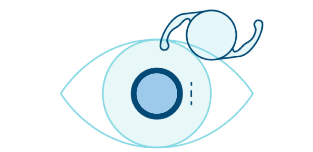 An illustration shows an eyeball with a blue circular overlay and a curved arrow above it, symbolizing the clarity achieved through LASIK eye surgery.