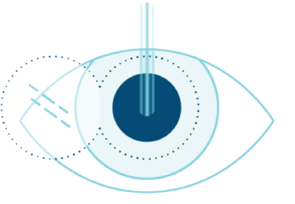 An eye with concentric circles and lines, illustrates the precision in LASIK eye surgery.