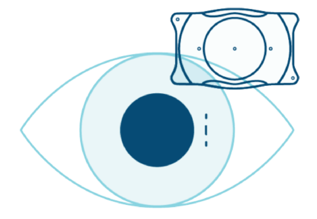 An illustration shows an eye with an overlay that displays a lens implant design, complementing the intricate process of LASIK eye surgery.