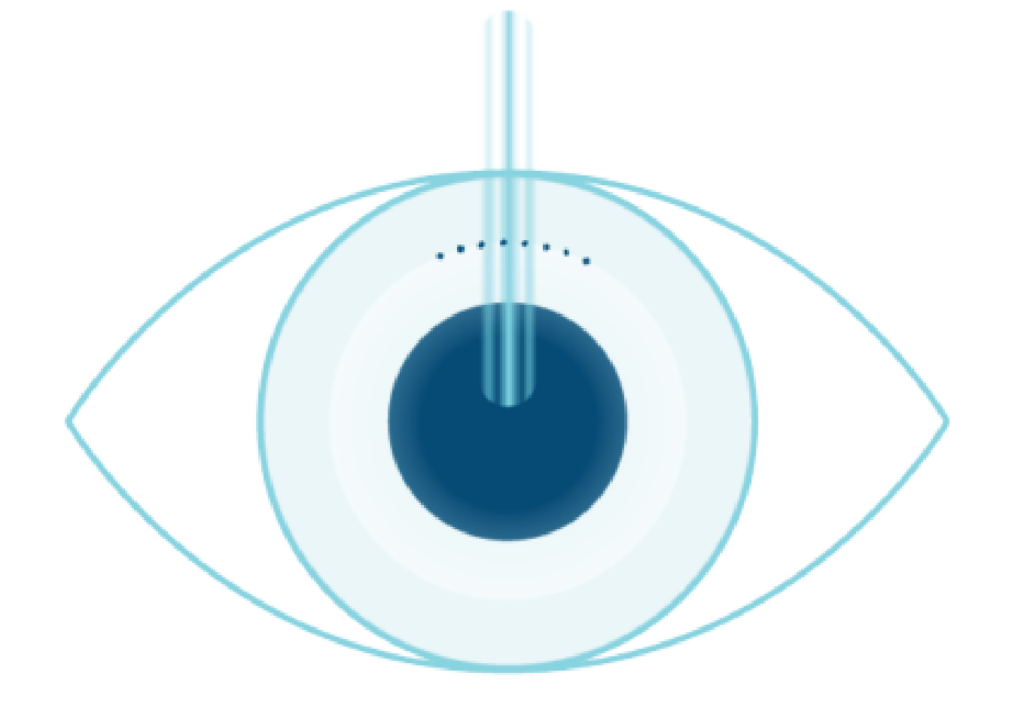 A laser beams directly at the pupil of an eye with a blue iris, demonstrating ClearSight through LASIK eye surgery, surrounded by dotted lines.