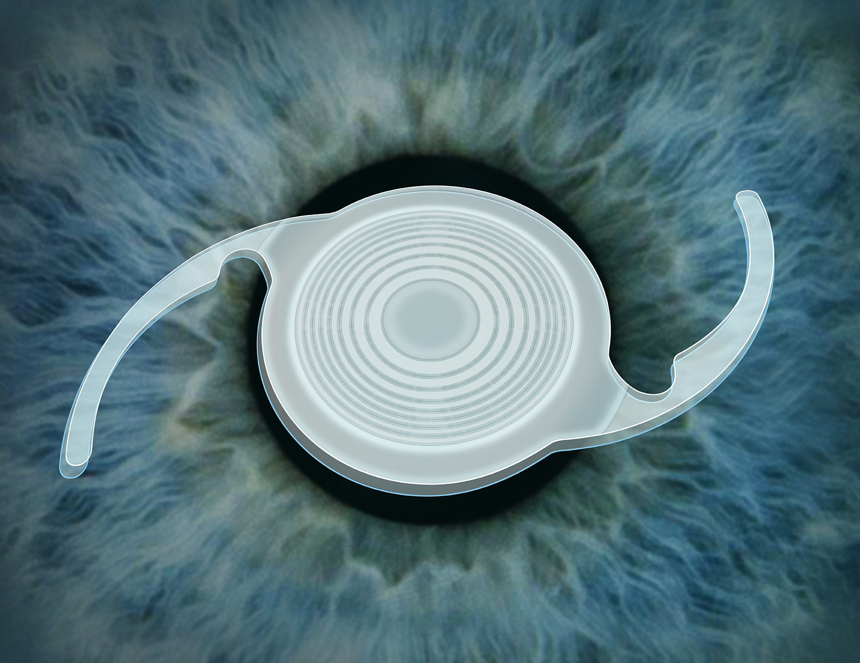 A close-up illustration shows an intraocular lens implant—commonly used in cataract surgery or custom lens replacement—superimposed over a human iris.